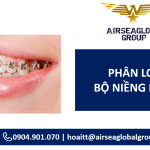 BỘ NIỀNG RĂNG PHÂN LOẠI GÌ?